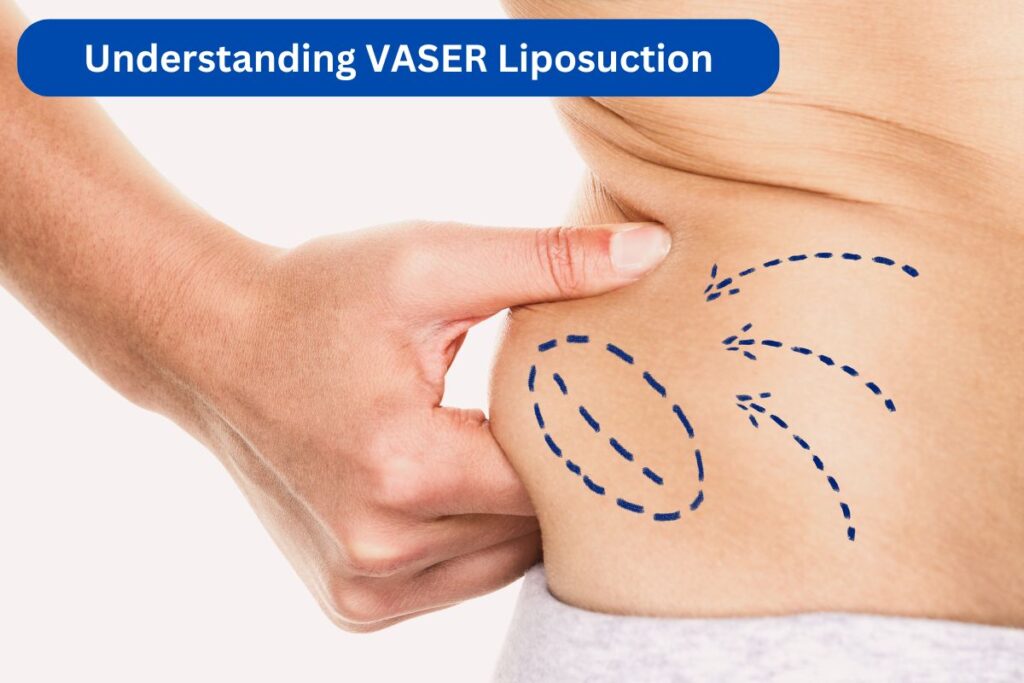 Understanding VASER liposuction for body sculpting