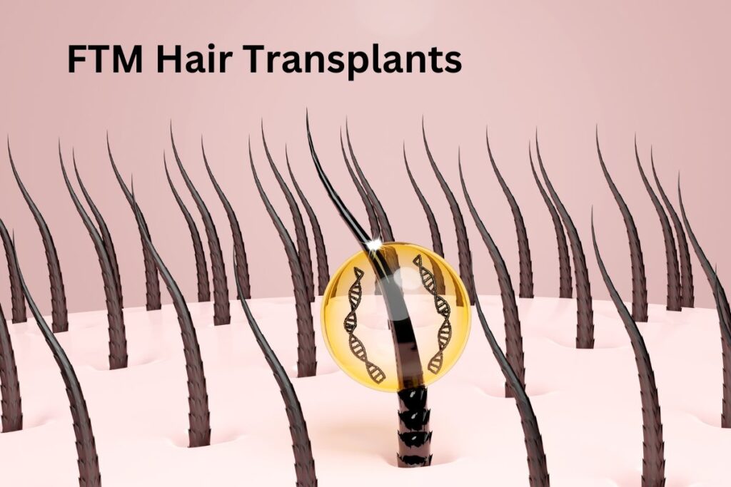 Female to Male Hair Transplants